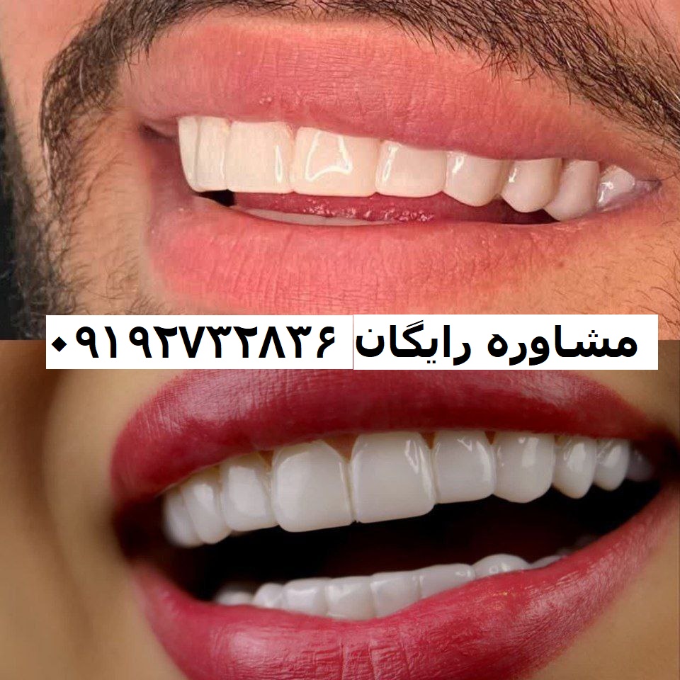 لمینت متجرک دندان بالا و پایین بصورت رنگ طبیعی با مشاوره رایگان